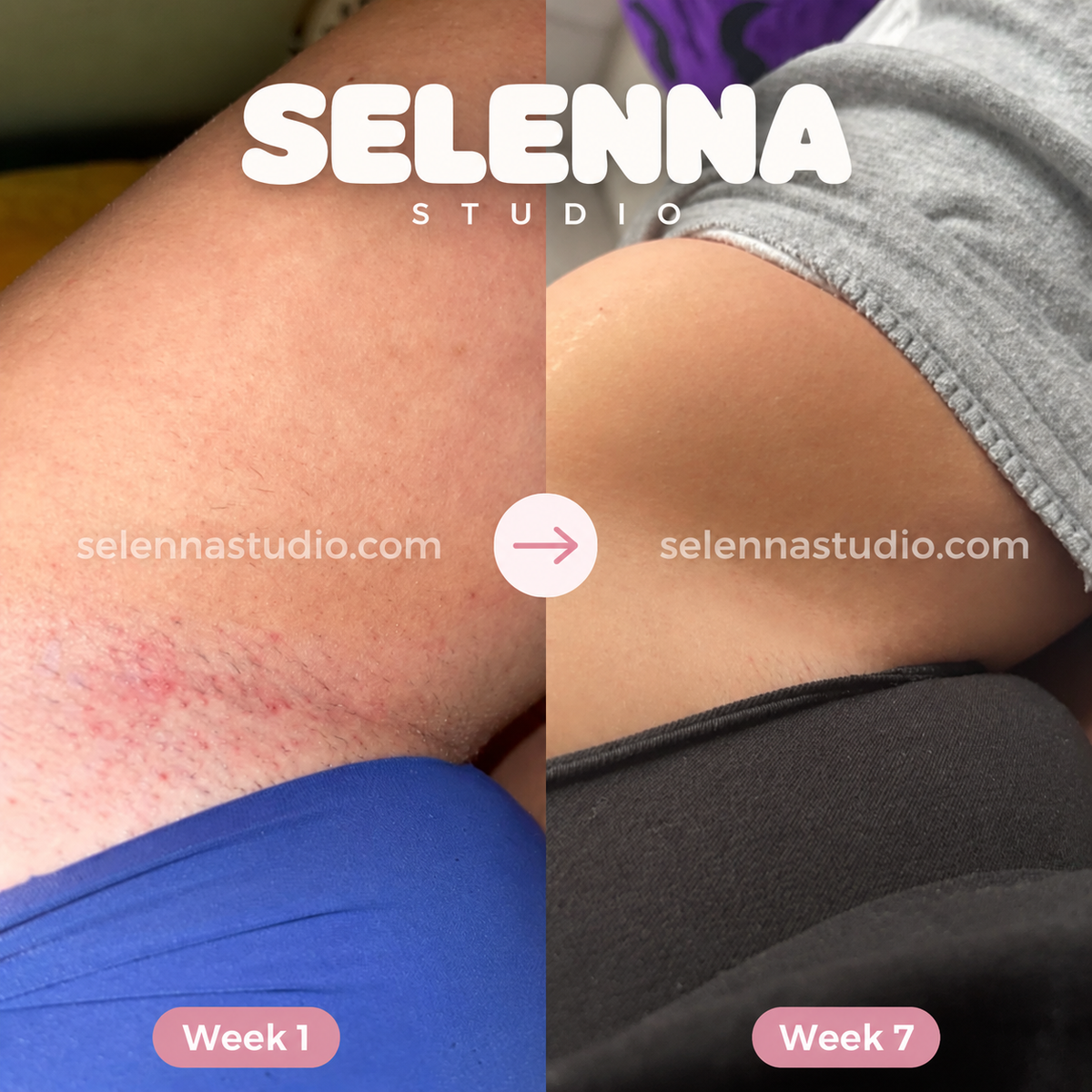 SELENNA IPL PRO™